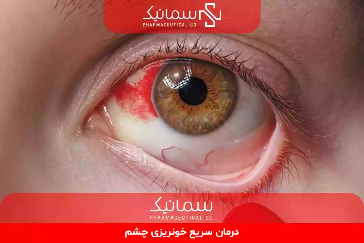 درمان سریع خونریزی چشم 