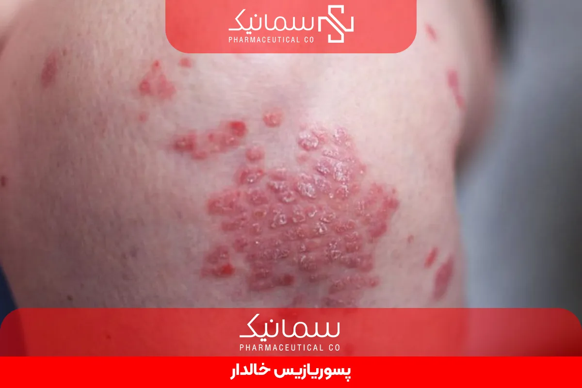 پسوریازیس خالدار
