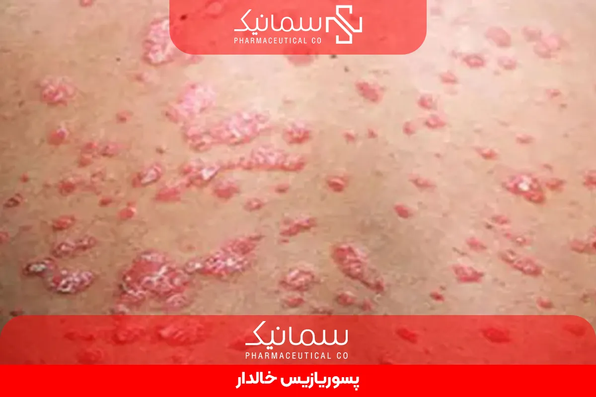 پسوریازیس خالدار