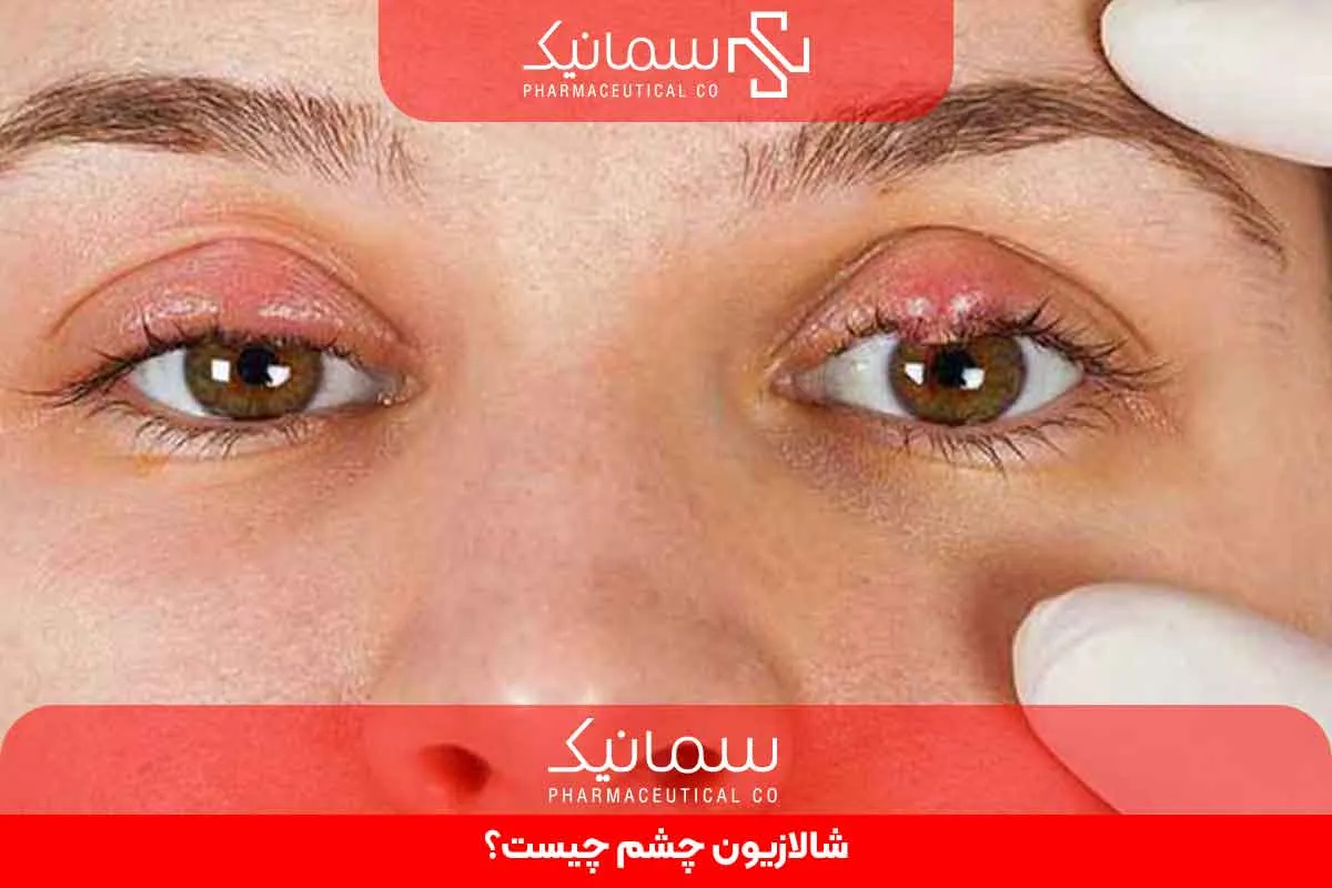 شالازیون چشم