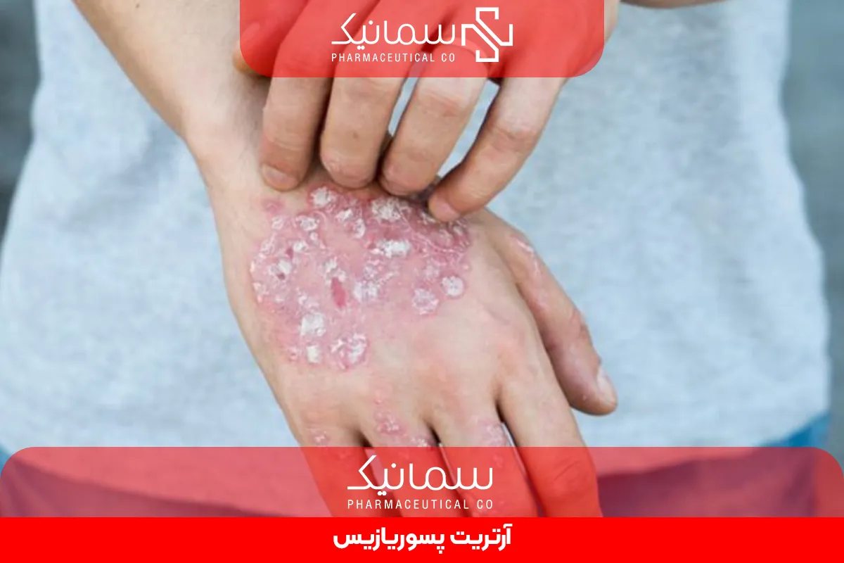 آرتریت پسوریازیس