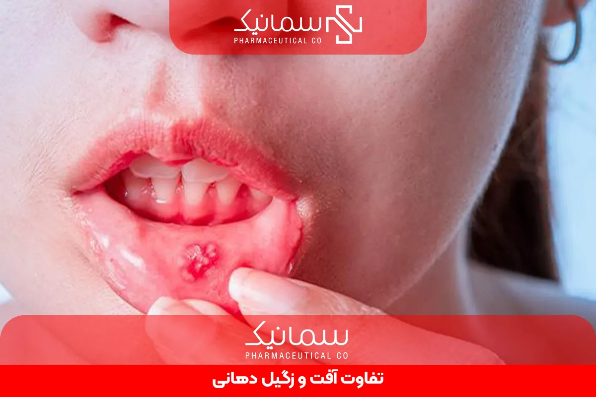 تفاوت آفت و زگیل دهانی