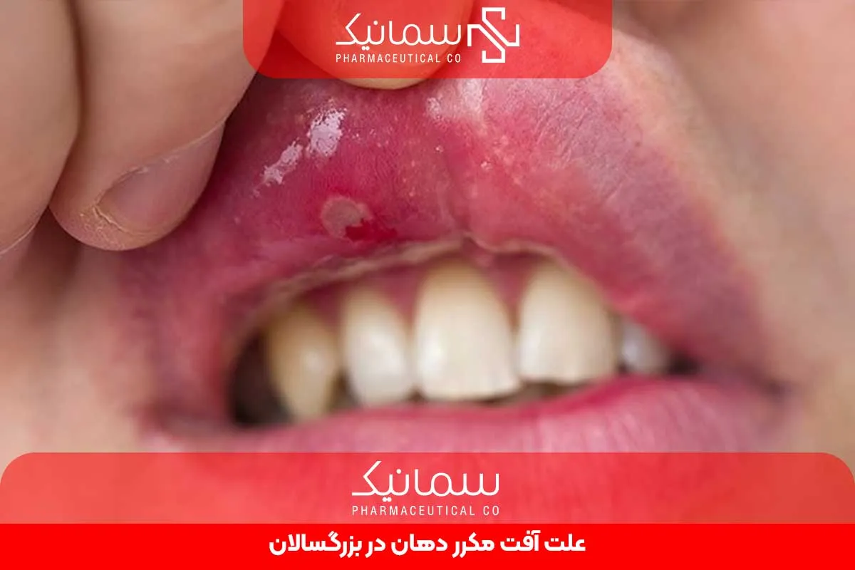 علت آفت مکرر دهان در بزرگسالان