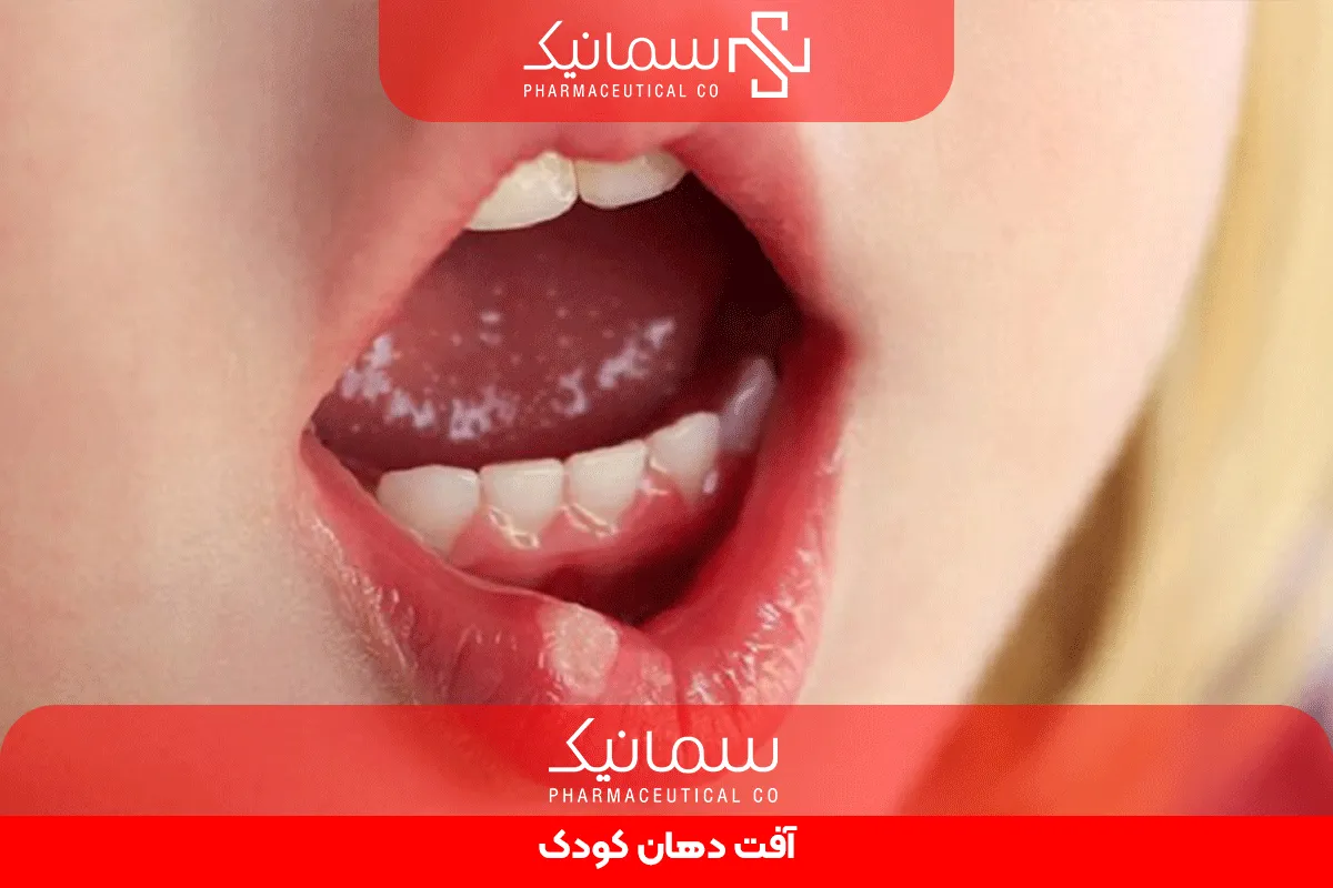 آفت دهان کودک
