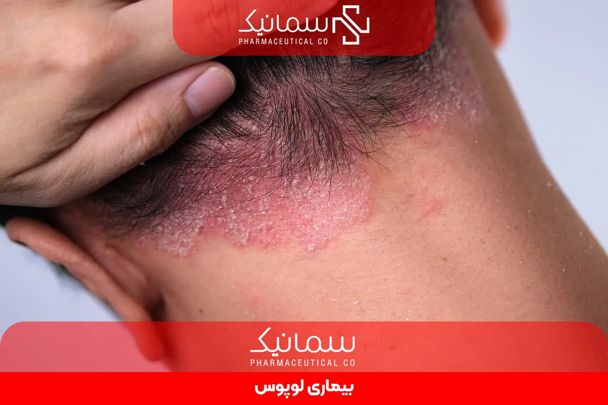 بیماری لوپوس