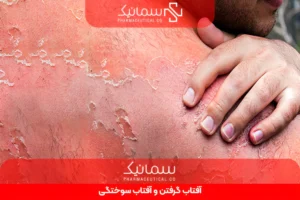 آفتاب گرفتن و آفتاب سوختگی