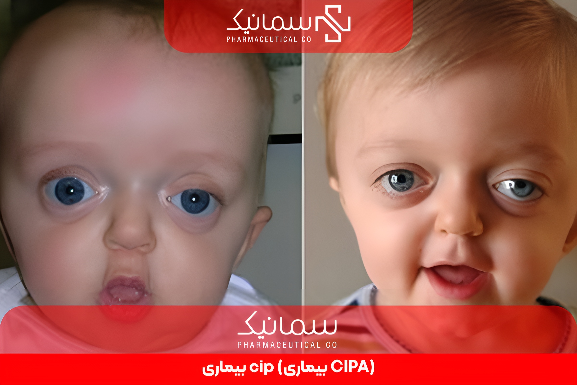 بیماری cip (بیماری CIPA)