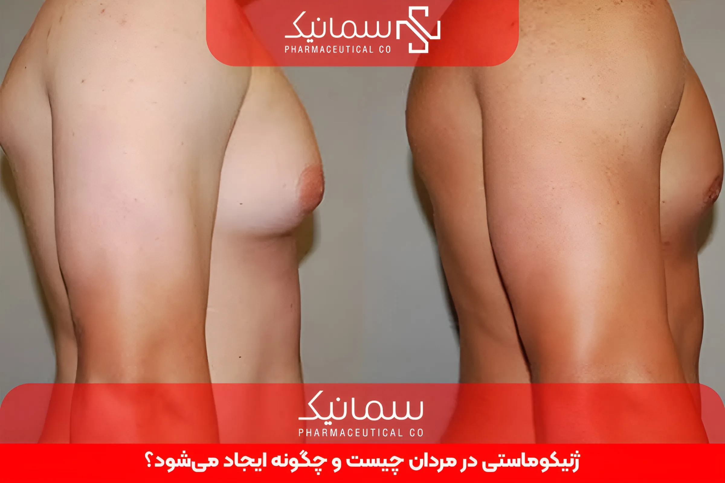 ژنیکوماستی در مردان چیست و چگونه ایجاد می‌شود؟