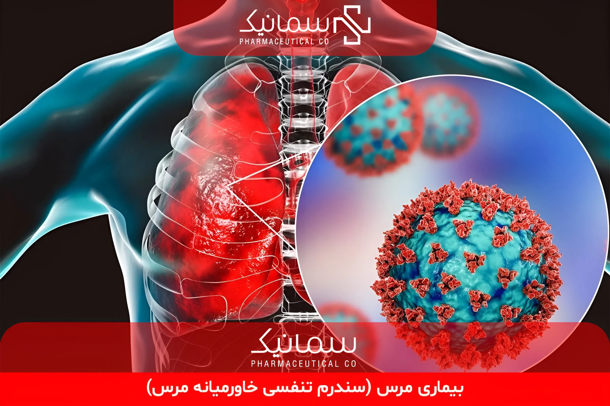 بیماری مرس (سندرم تنفسی خاورمیانه مرس)