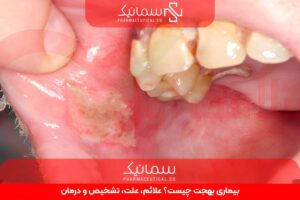 بیماری بهجت چیست؟ علائم، علت، تشخیص و درمان