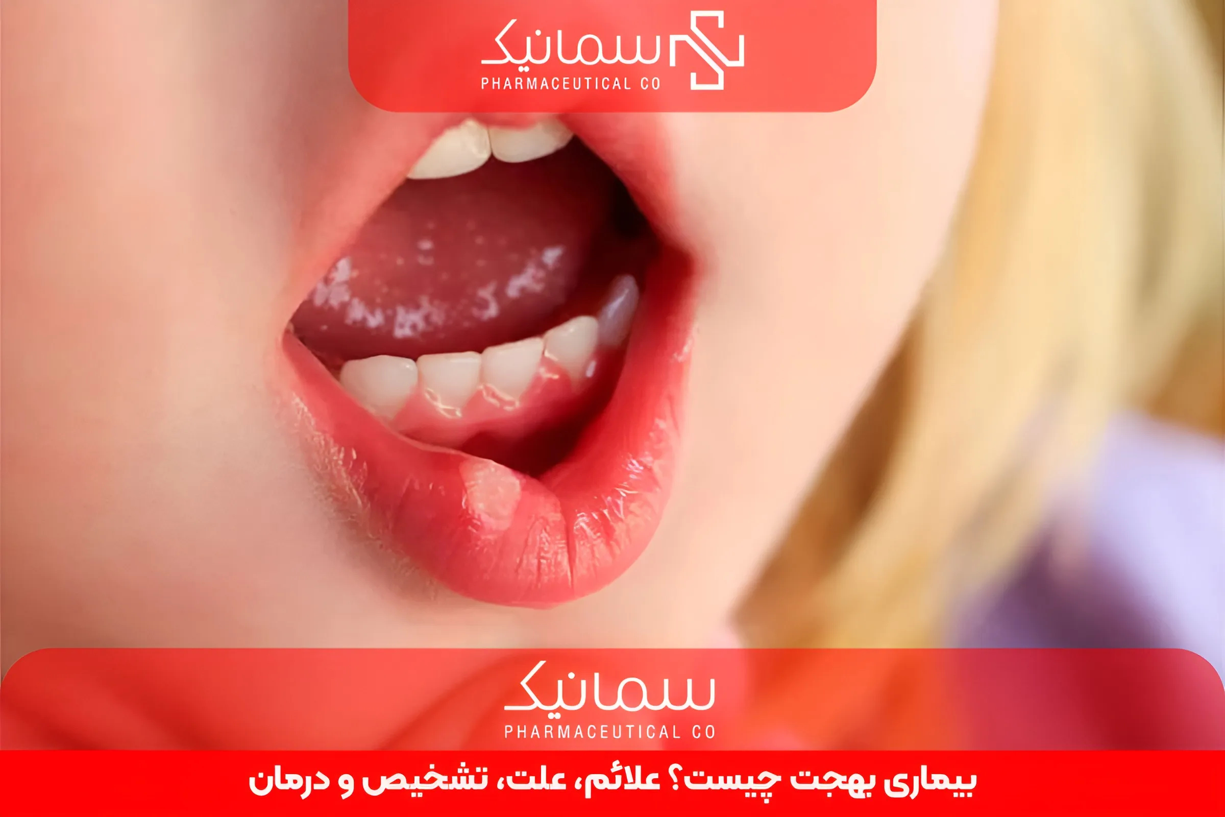 بیماری بهجت چیست؟ علائم، علت، تشخیص و درمان
