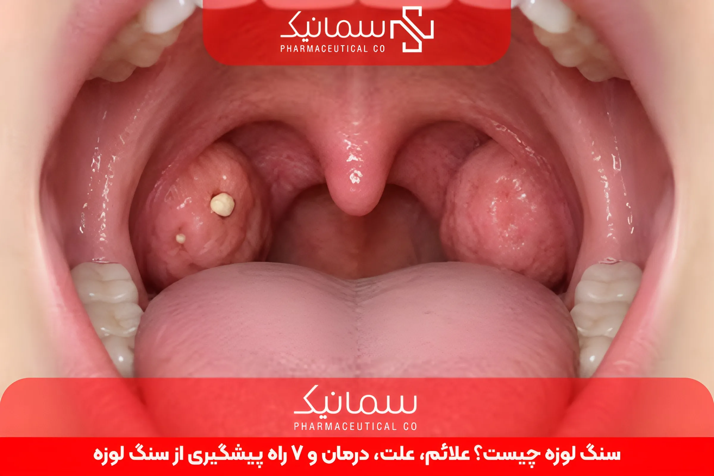 سنگ لوزه چیست؟ علائم، علت، درمان و 7 راه‌ پیشگیری از سنگ لوزه