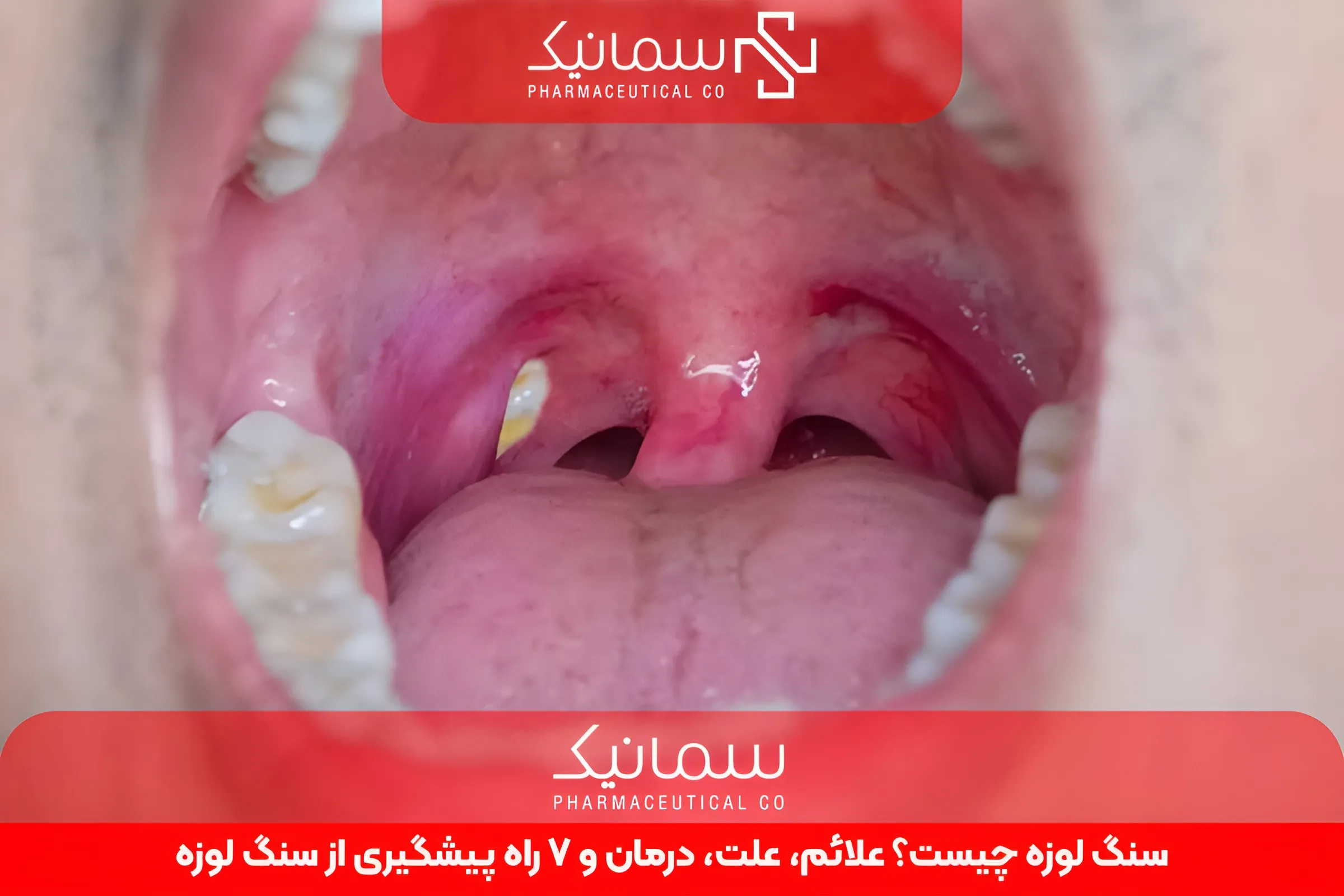 سنگ لوزه چیست؟ علائم، علت، درمان و 7 راه پیشگیری از سنگ لوزه