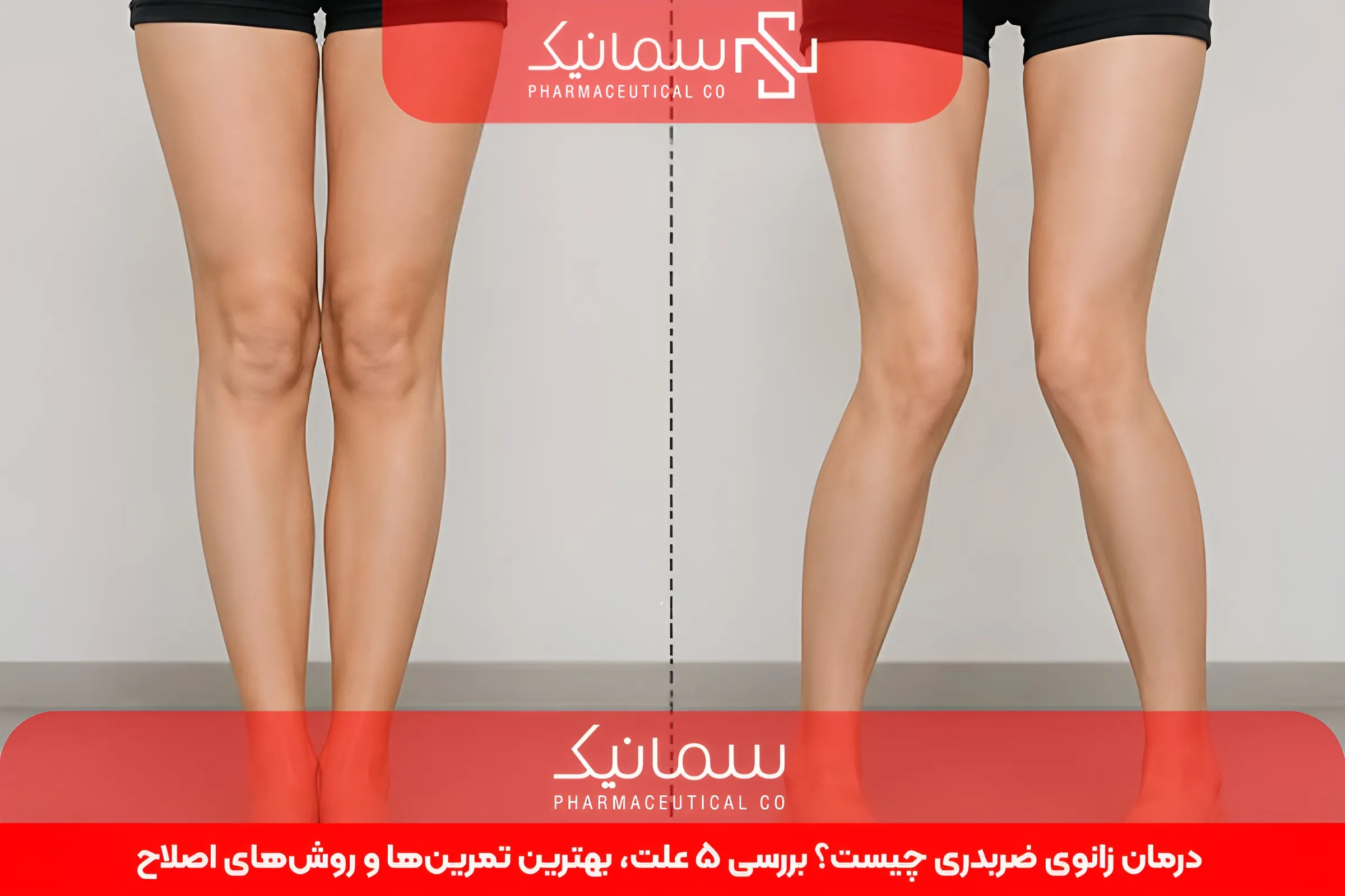 درمان زانوی ضربدری چیست؟ بررسی 5 علت، بهترین تمرین‌ها و روش‌های اصلاح